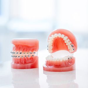a close-up of a model of braces