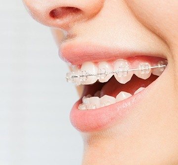 Close up of clear braces.