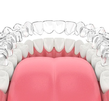 A digital image of a clear Invisalign aligner going on over the lower arch of teeth