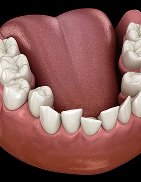 Illustration of crowded teeth