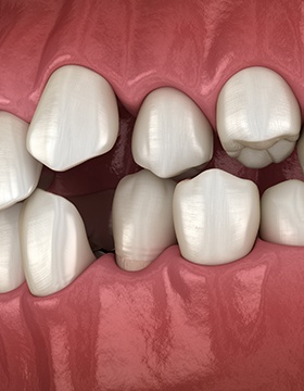 Illustration of gapped teeth