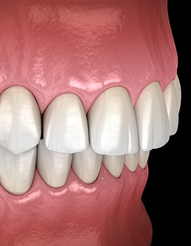 Illustration of an overbite