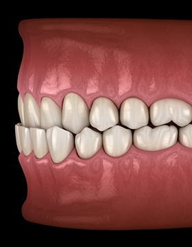 Illustration of an underbite