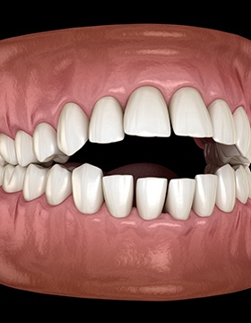 Illustration of an open bite