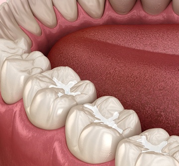 Diagram showing dental sealants in Pelham