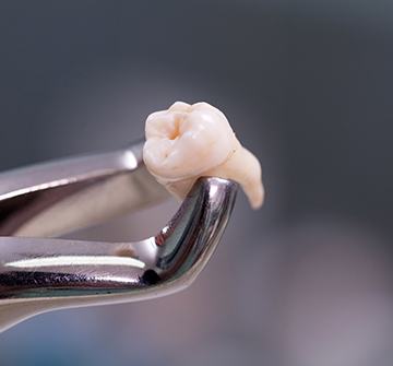 Metal clasp holding extracted tooth