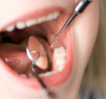 Closeup of child’s mouth with tooth-colored filling in Pelham