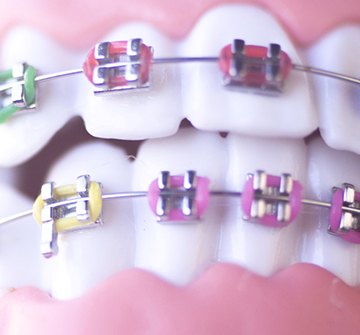 fun, colorful braces 