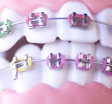fun, colorful braces