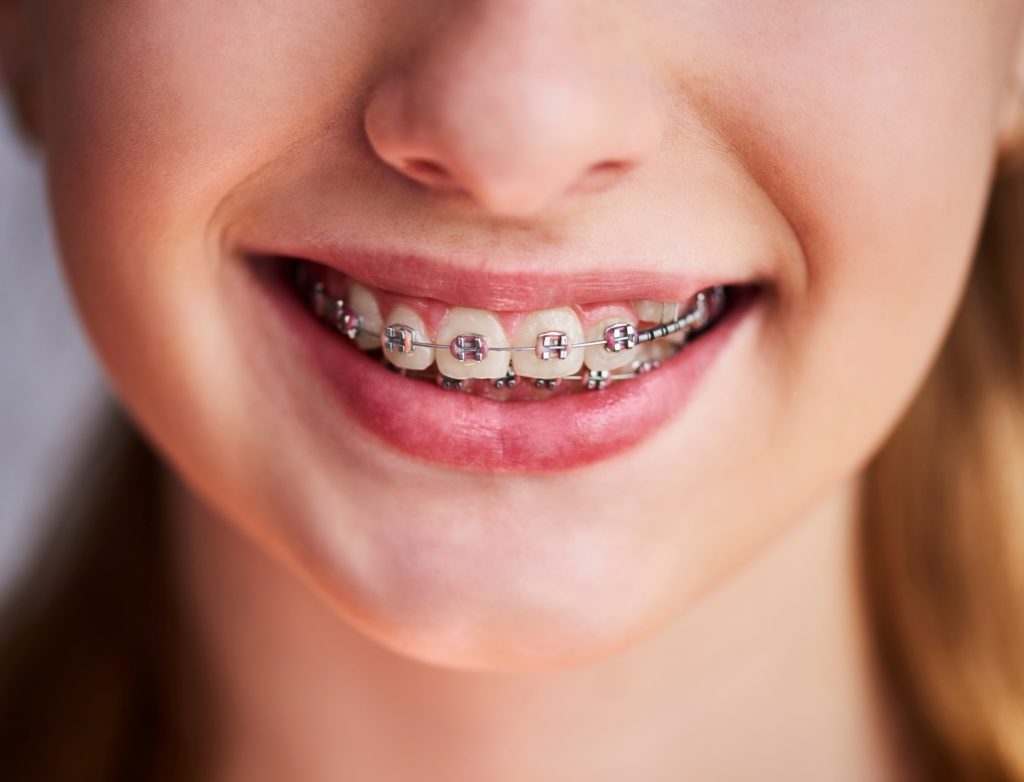 Closeup of child with Phase 1 Orthodontics smiling