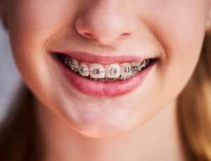 a child with braces smiling 