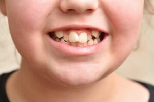 Close-up view of a child’s crooked teeth
